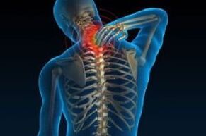 Osteochond osteochondrosis cervical na-eduga na Sereness
