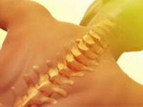 osteochondrosis - ọrịa spain