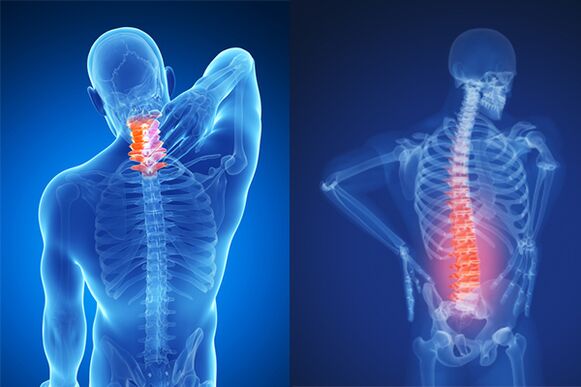 Osteochondrosis nke cervical na lumbar spain
