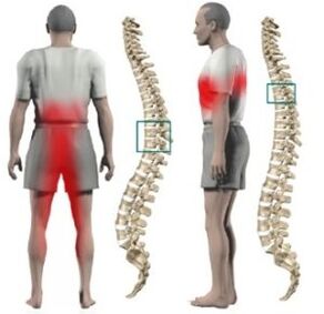 Protrusion na ọkpụkpụ azụ