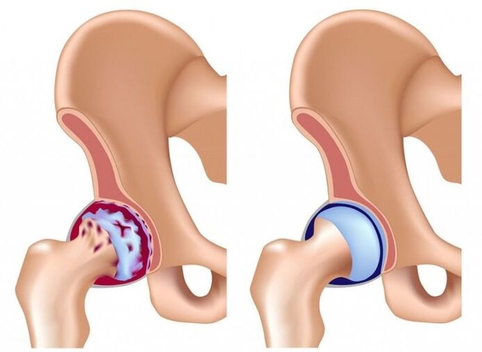 Mmebi nke nkwonkwo hip n'ihi arthrosis