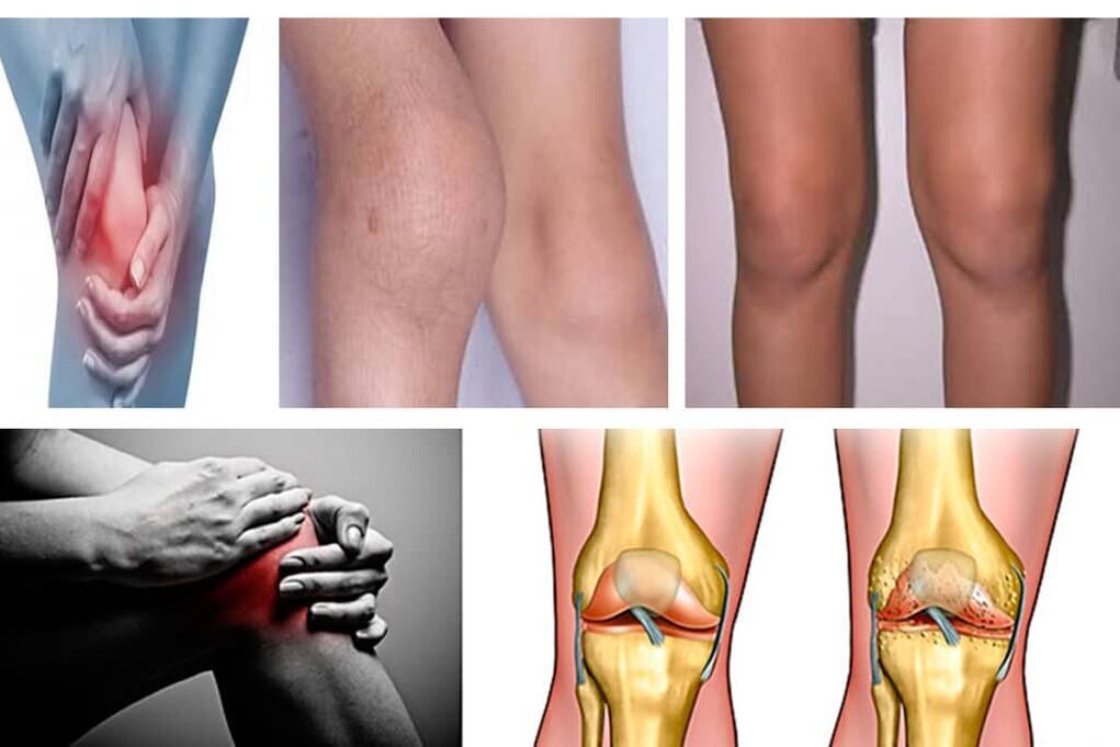 arthrosis kedu ihe ọ bụ
