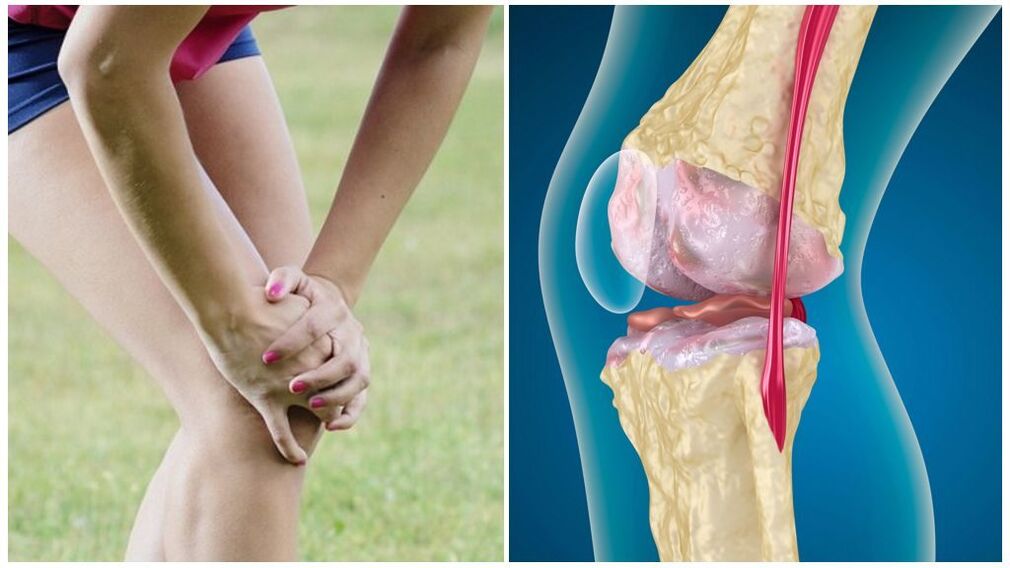 mgbaàmà nke arthrosis