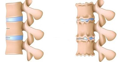 Etu esi amata ọnụnọ nke osteochondrosis nke lumbar