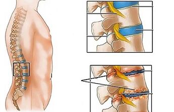 Ihe ndị na-akpata osteochondrosis nke lumbar